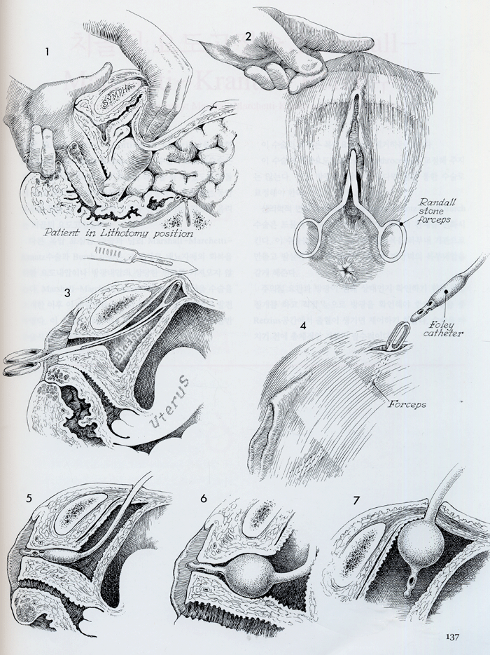 그림으로 보는 골반수술