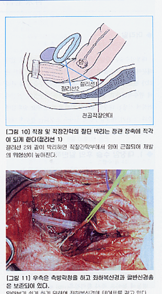 대장항문외과 요점과 맹점