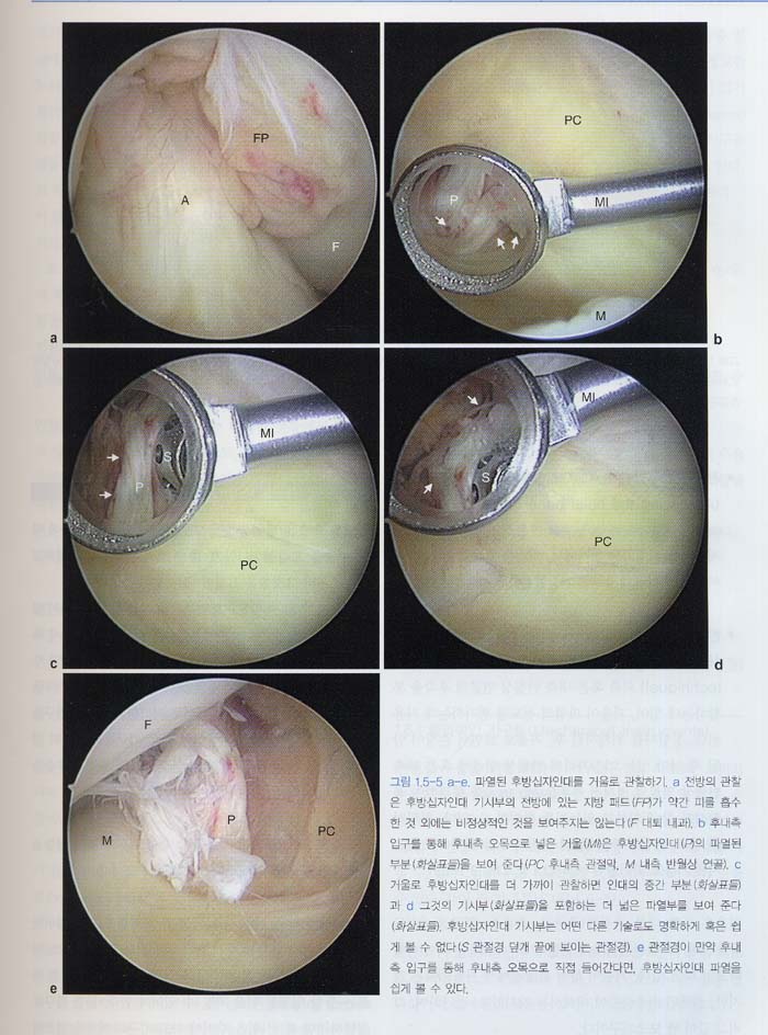 관절경외과학 : manual of arthroscopic surgery