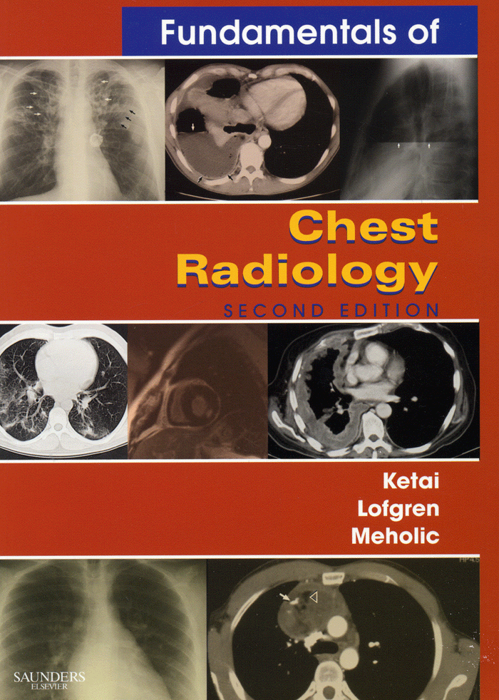 Fundamentals of Chest Radiology 2th