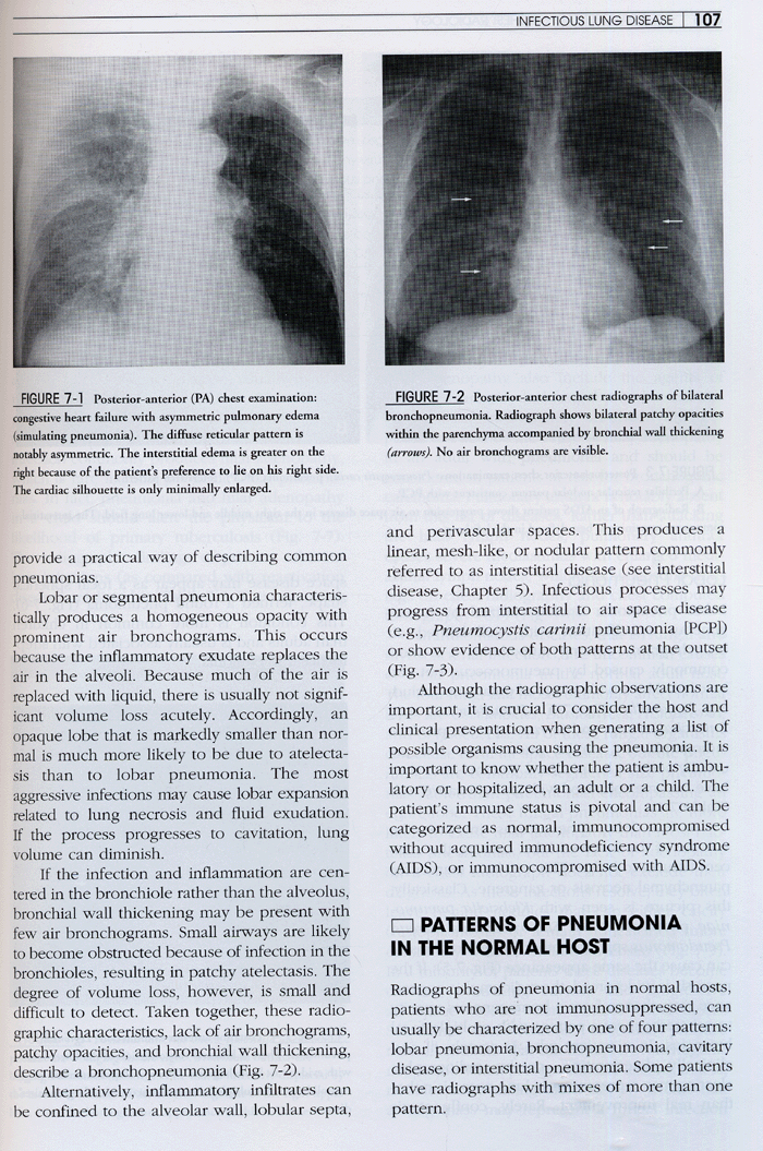 Fundamentals of Chest Radiology 2th