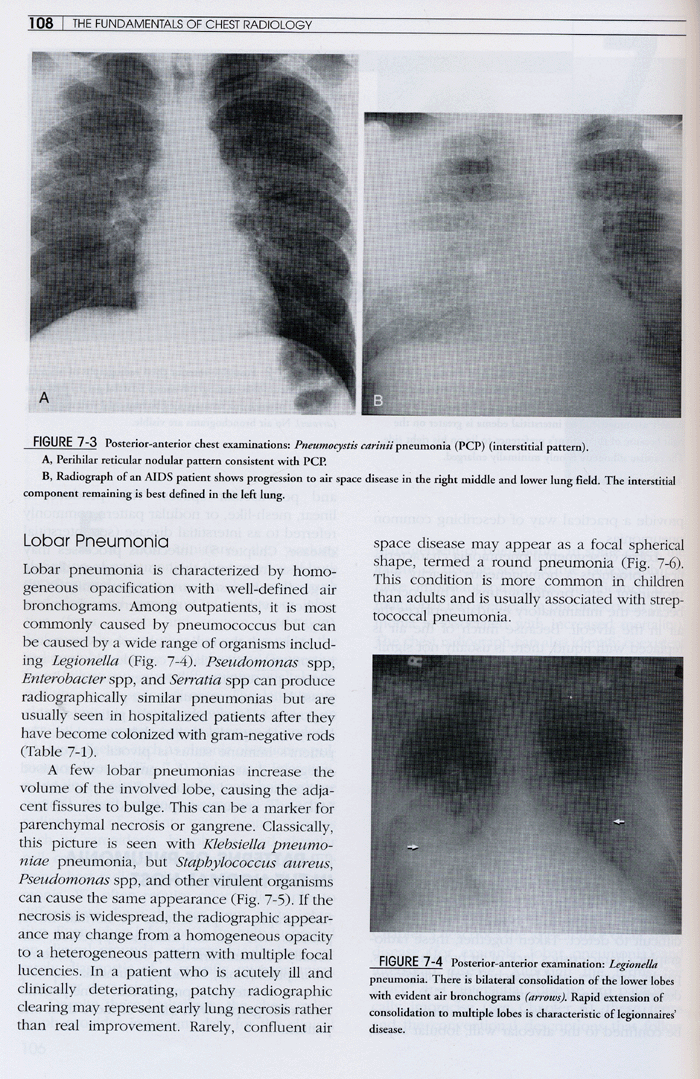 Fundamentals of Chest Radiology 2th