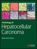 Pathology of Hepatocellular Carcinoma