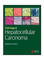 Pathology of Hepatocellular Carcinoma