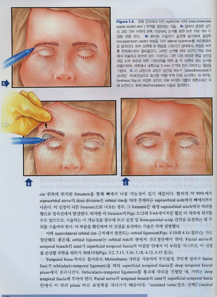 이마와 관자부위 미용성형 : 해부및술기