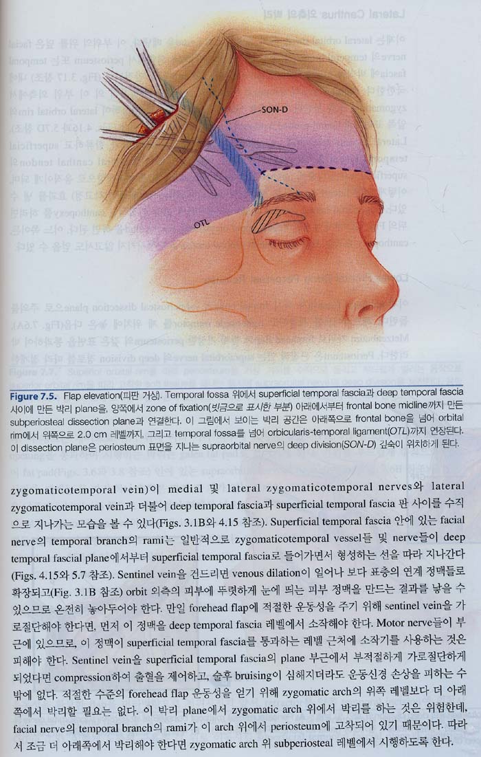 이마와 관자부위 미용성형 : 해부및술기