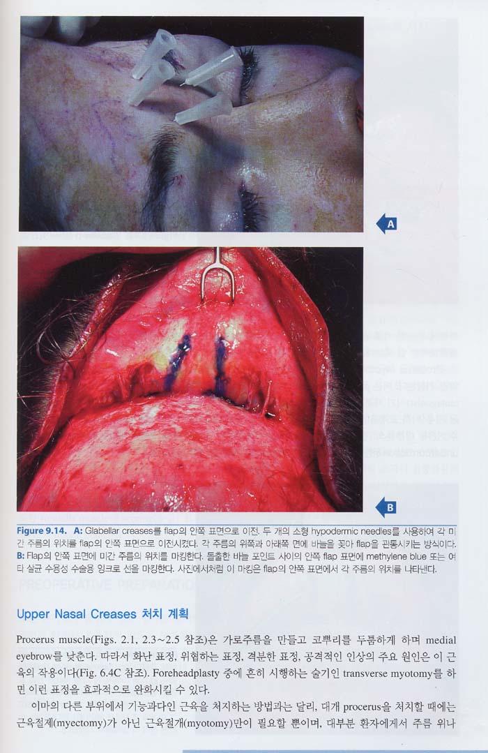 이마와 관자부위 미용성형 : 해부및술기