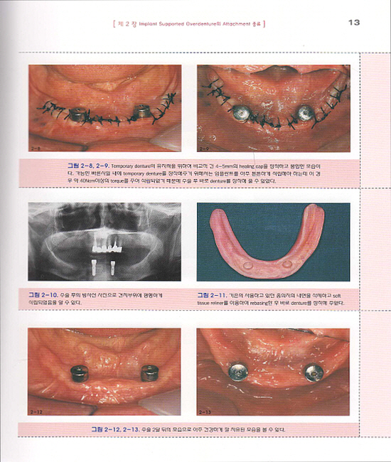 임플란트 유지형 가철성 보철물(Guide to Implant Supported Overdenture)