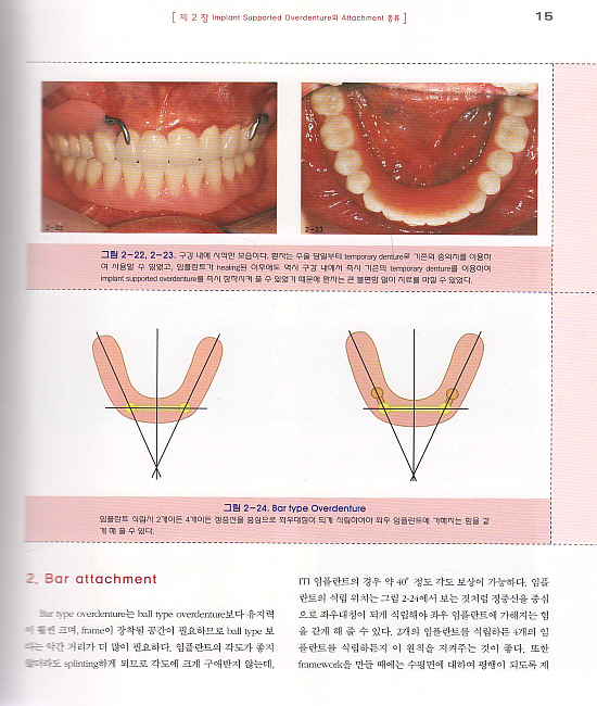 임플란트 유지형 가철성 보철물(Guide to Implant Supported Overdenture)