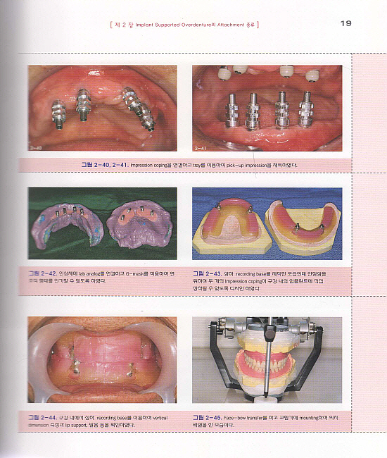 임플란트 유지형 가철성 보철물(Guide to Implant Supported Overdenture)