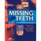 Missing Teeth: A Guide to Treatment Options