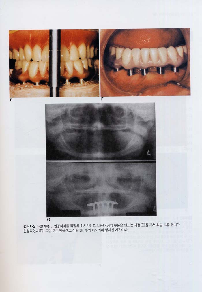 무치악 보철 치료학 12판 (Prosthodontic Treatment for Edentulous Patients) - 총의치학 및 임플랜트학