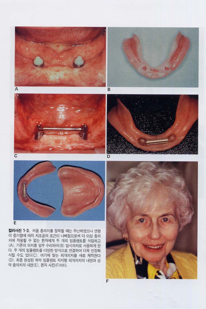 무치악 보철 치료학 12판 (Prosthodontic Treatment for Edentulous Patients) - 총의치학 및 임플랜트학