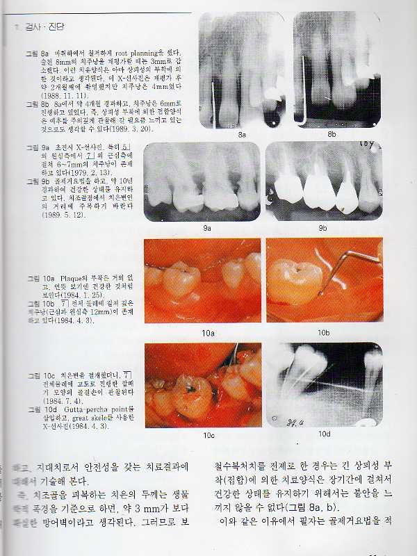 One point advice Crown Bridge의 임상