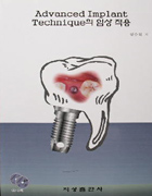 Advanced Implant Techique의 임상 적용(CD 포함)