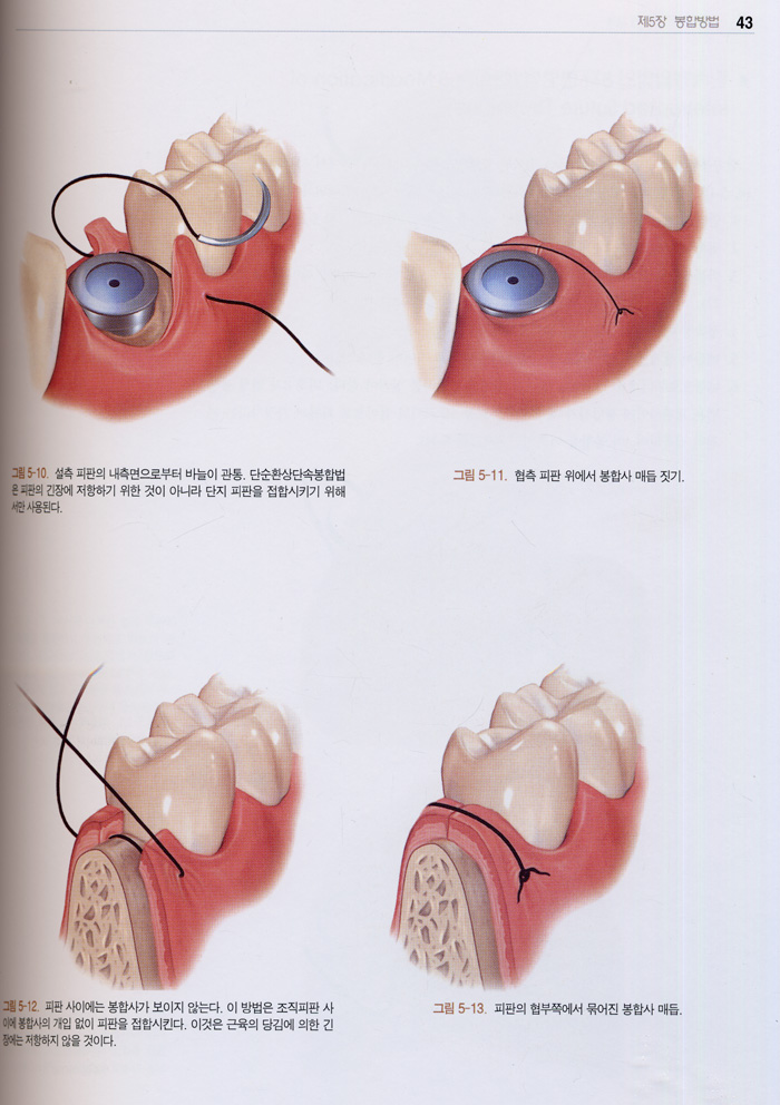 치과 임플란트 봉합술 외과적 봉합술 지침서