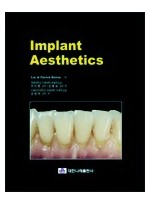 Implant Aesthetics