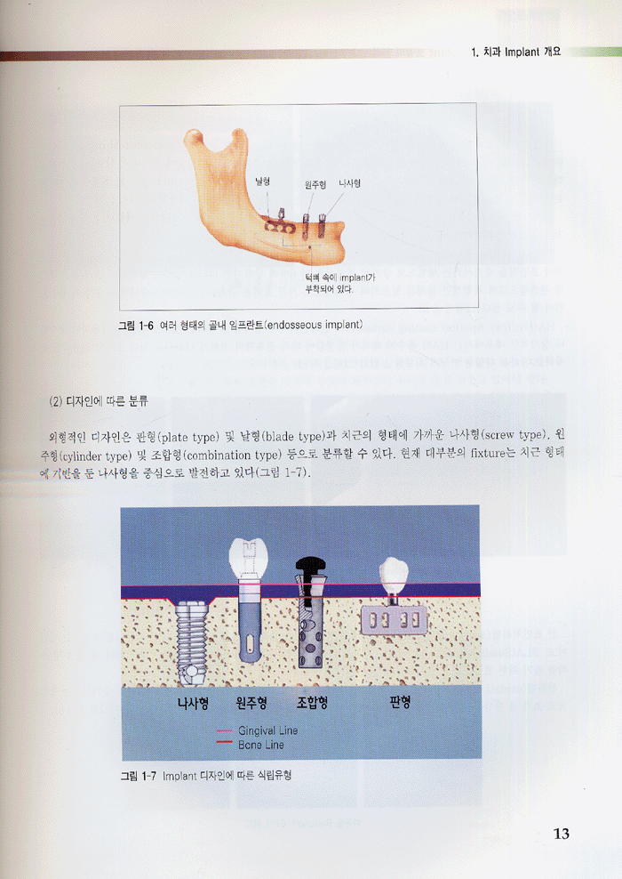 최신 치과 IMPLANT 보철기공 2판