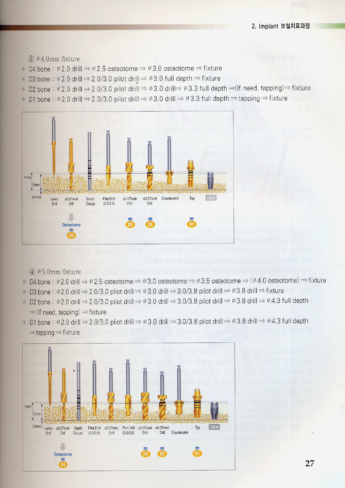 최신 치과 IMPLANT 보철기공 2판