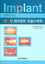 증례로 보는 다양한 임프란트 보철수복학