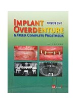 IMPLANT OVERDENTURE & Fixed Complete Prosthesis