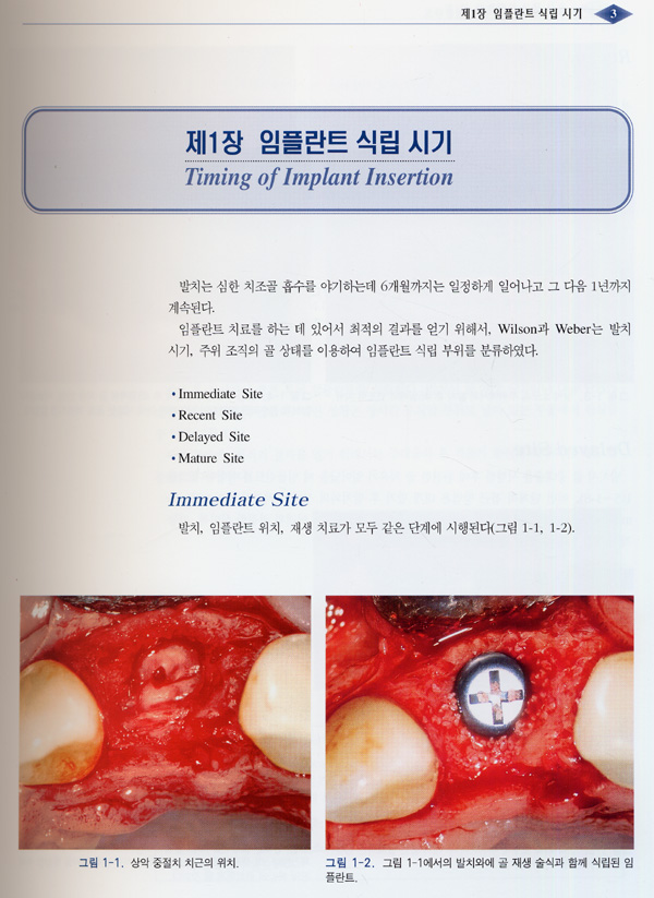 발치 후 즉시 식립 임플란트 & 치조정 접근법에 의한 상악동 거상술