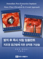 발치 후 즉시 식립 임플란트 & 치조정 접근법에 의한 상악동 거상술