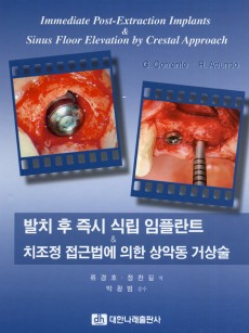 발치 후 즉시 식립 임플란트 & 치조정 접근법에 의한 상악동 거상술