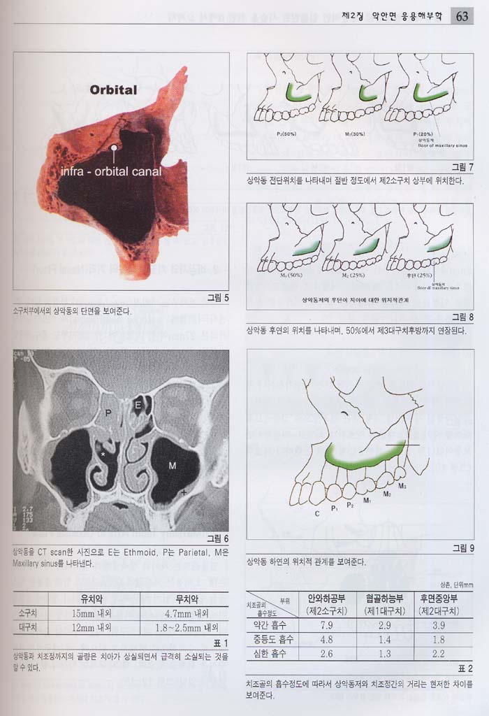 골유착성 임플란트