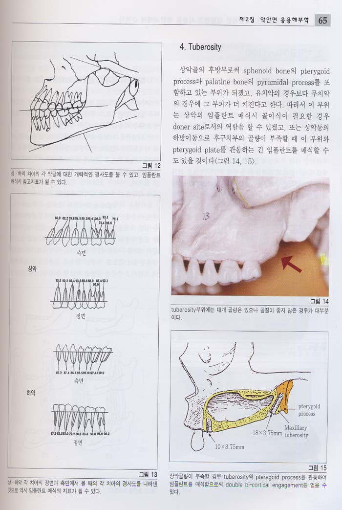 골유착성 임플란트