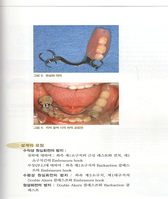 국소의치 아틀라스 - 설계이론과 임상 유리단 국소의치를 중심으로