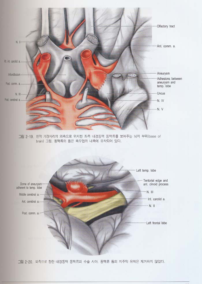 kempe\'s Operative Neurosurgery 임상수술학 (전2권)