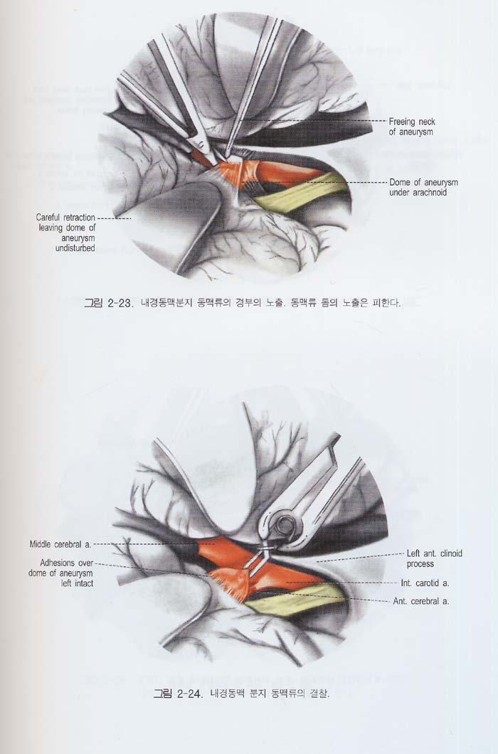 kempe\'s Operative Neurosurgery 임상수술학 (전2권)