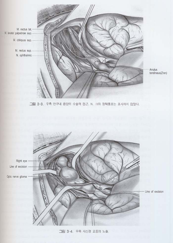 kempe\'s Operative Neurosurgery 임상수술학 (전2권)