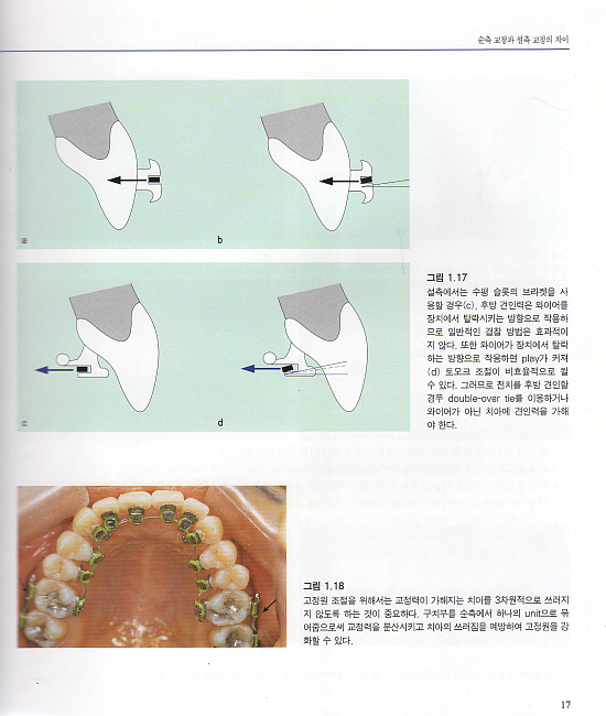 도해로 보는 최신 성인교정치료 Vol.II - 설측교정치료