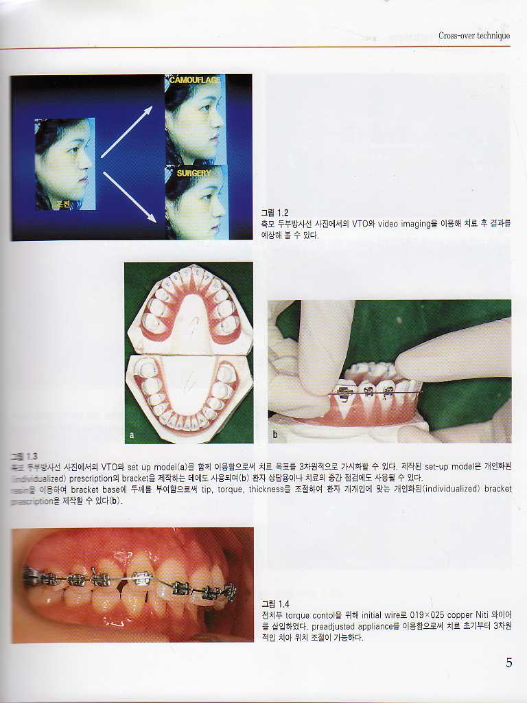 도해로 보는 최신 성인교정치료 Vol. I - 간단하고 효율적인 발치치료 -