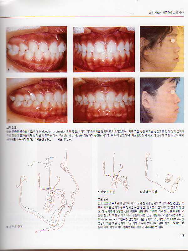 도해로 보는 최신 성인교정치료 Vol. I - 간단하고 효율적인 발치치료 -