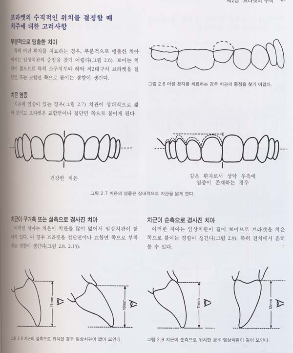 Preadjusted Appliance를 이용한 교정치료