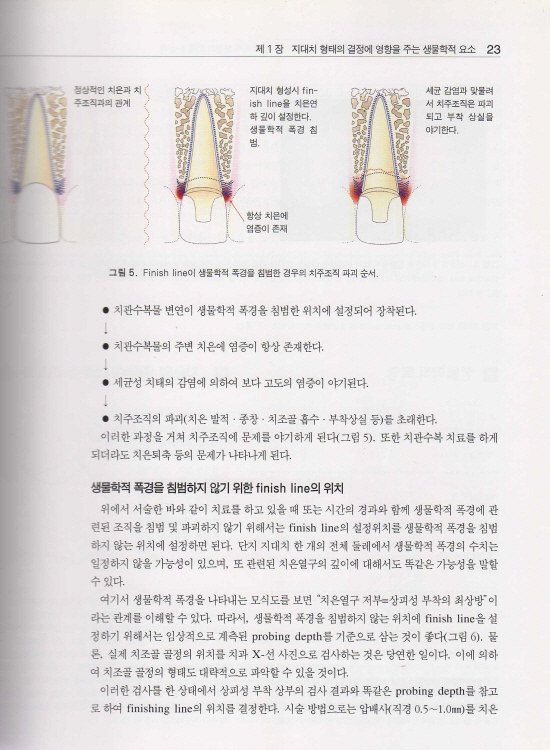 임상실력을 향상시키는 지대치 형성의 노하우