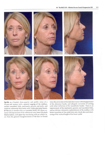 Aesthetic Surgery of the Facial Mosaic (with DVD)