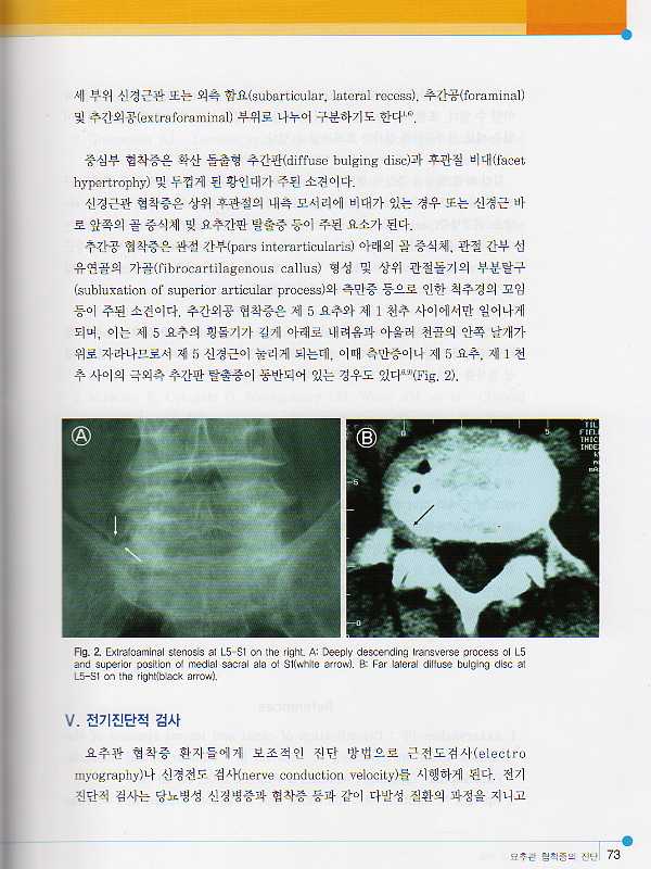 요추관 협착증의 진단과 치료