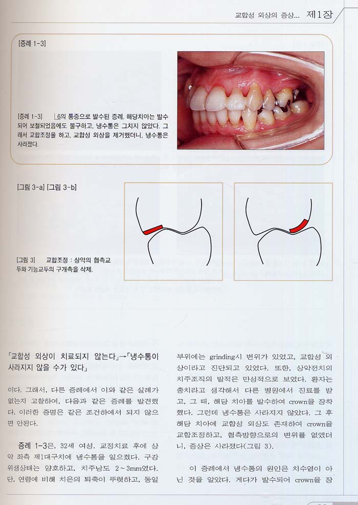 교합성 외상의 조기진단과 치료법