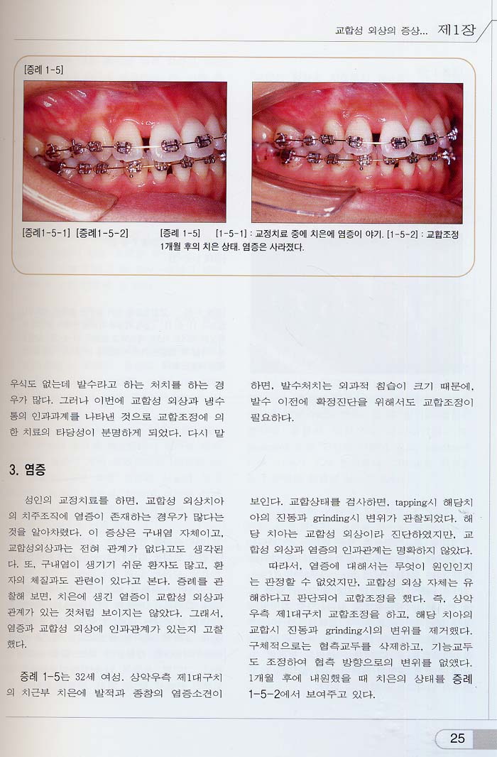 교합성 외상의 조기진단과 치료법