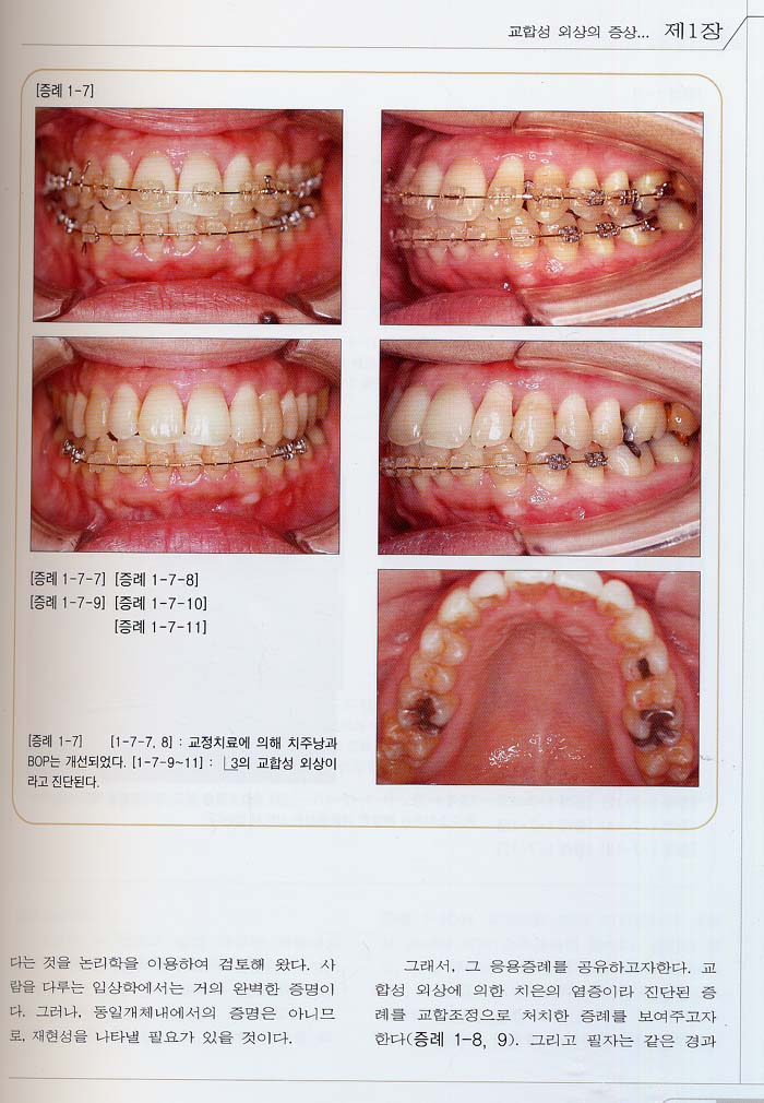 교합성 외상의 조기진단과 치료법