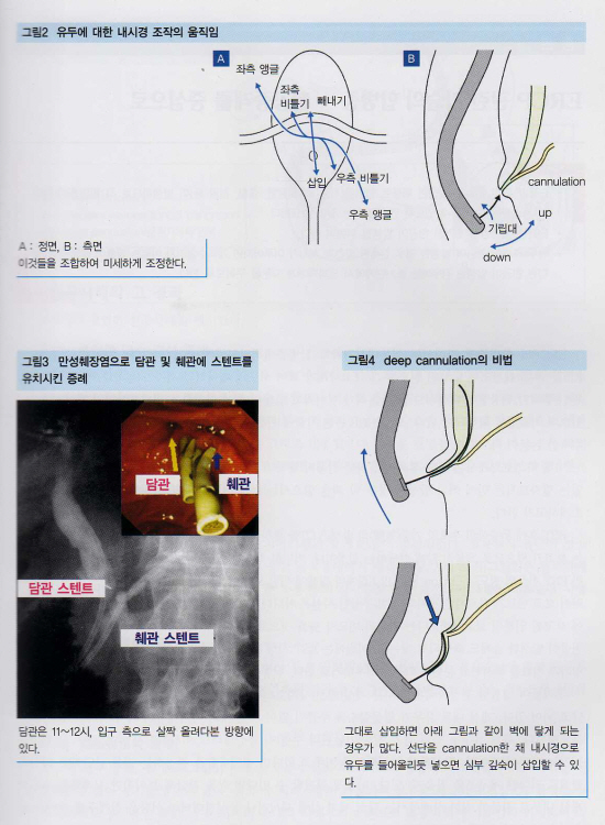 췌 담도 치료내시경의 실제