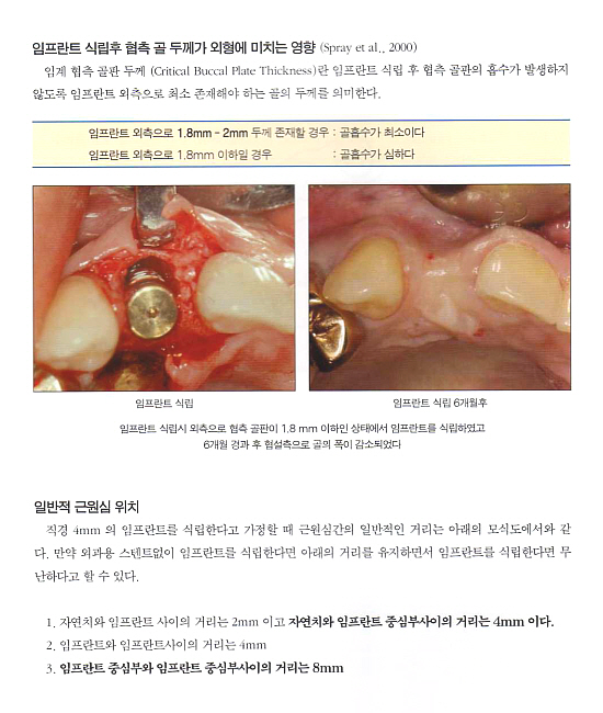 치주-바탕 임프란트-치주치료에서 임프란트까지 - 2 임프란트