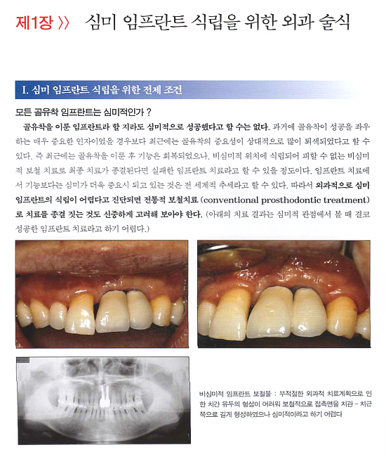 치주-바탕 임프란트-치주치료에서 임프란트까지 - 2 임프란트