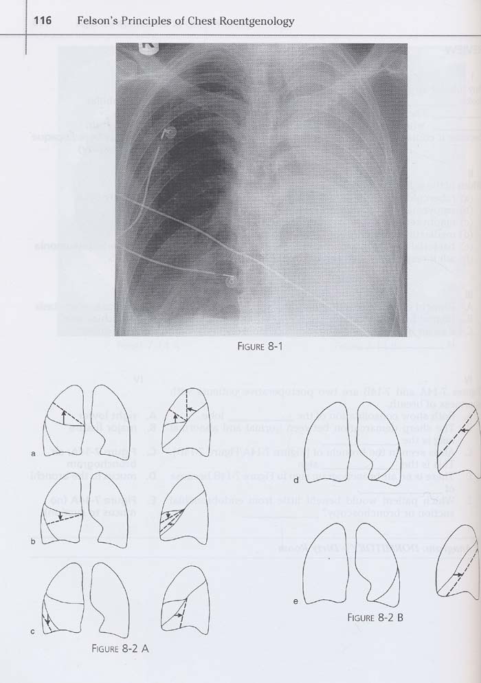 Felson's Principles of Chest Roentgenology Text with CD-ROM,3/e