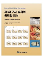 제3대구치 발치의 원리와 임상