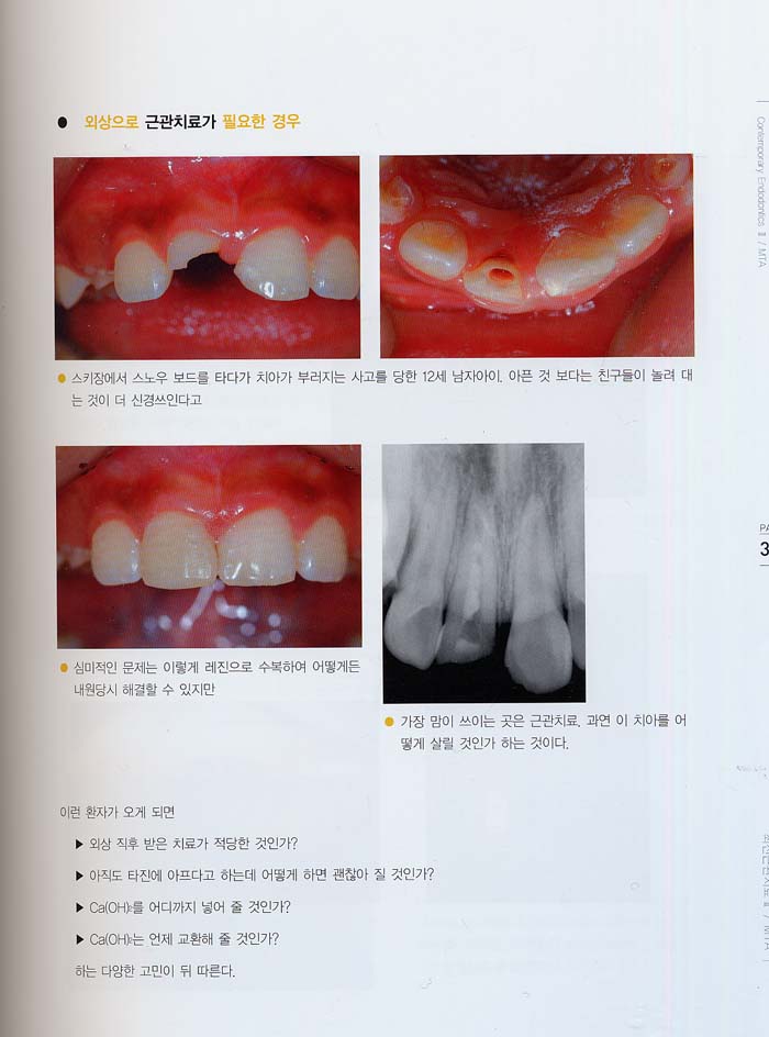 교과서에서 가르쳐주지않는 최신근관치료 II /MTA